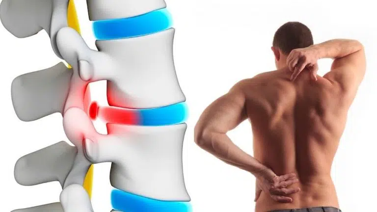 How can I build muscle with a herniated disc?