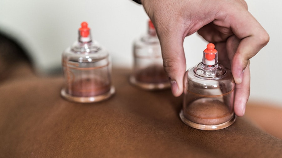 Cupping therapy session with suction cups placed on the back.